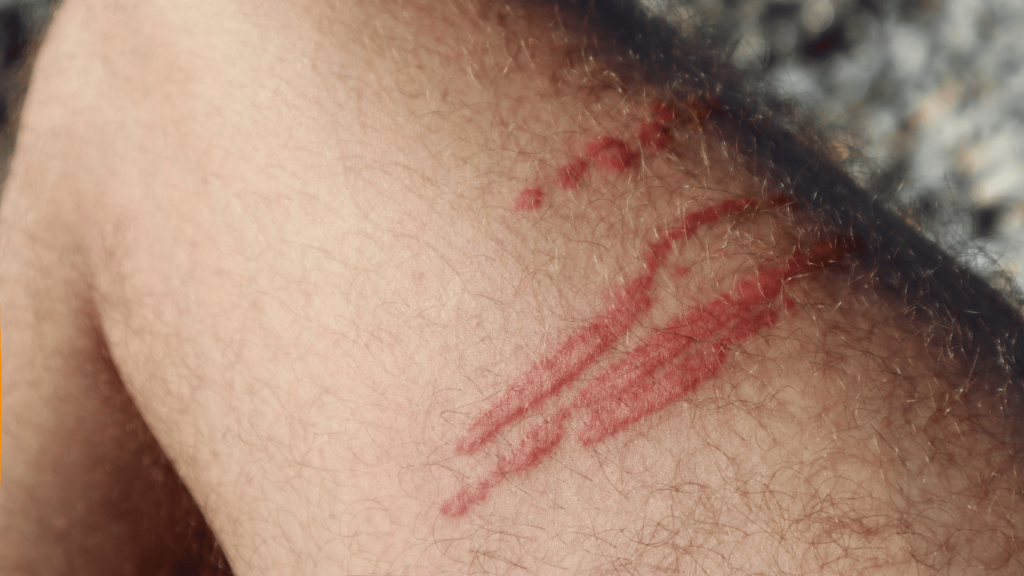 Pierna con picadura de medusa