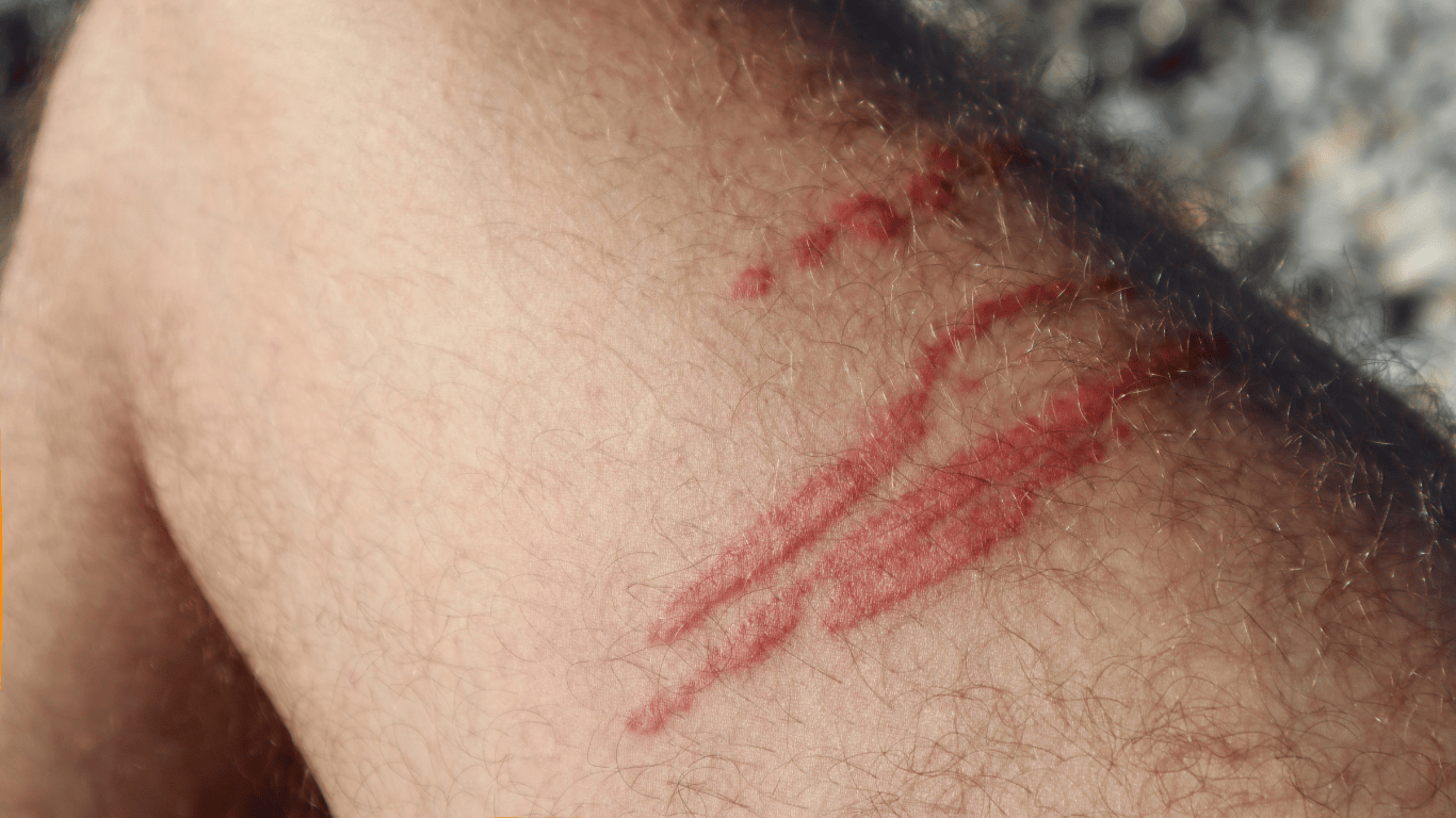 Pierna con picadura de medusa